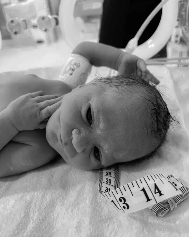 Ultrasound Missed It: C‑Section Reveals Baby’s Rare ‘Permanent Smile’